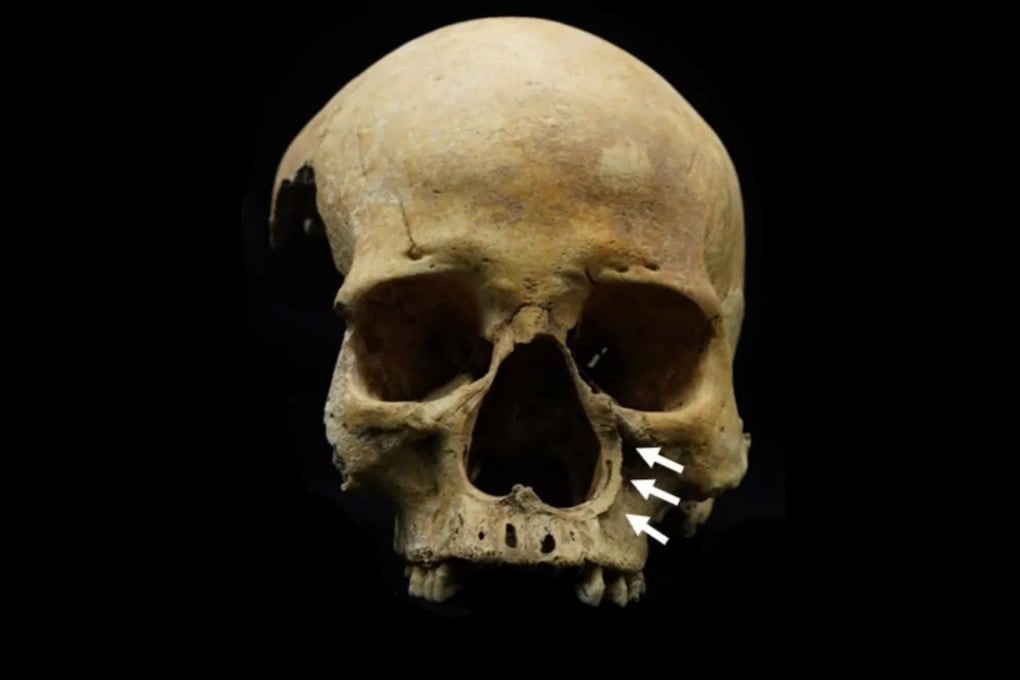 The skull above exhibits features consistent with nasal amputation. Archaeologists in China have uncovered the first physical evidence of nose-chopping, a historically documented punishment for cattle thieves. Photo: Yawei Zhou et al