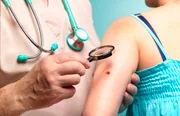 Novo exame de sangue que detecta mais de 50 tipos de câncer chega ao Brasil