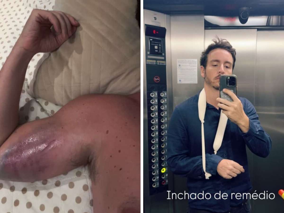Ator da Globo Wagner Santisteban mostra hematomas após acidente na academia: 'Doendo muito'